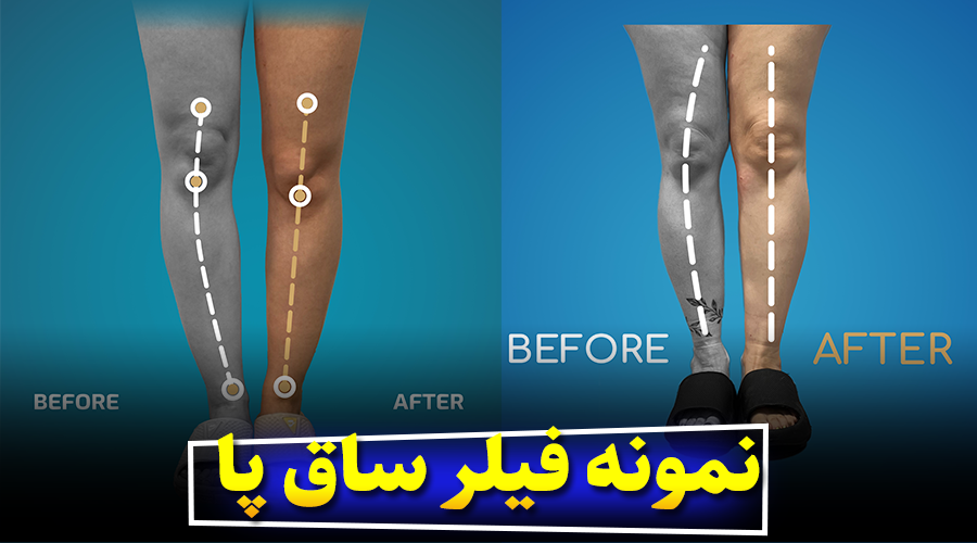چه کسانی کاندید مناسبی برای فیلر ساق پا هستند؟