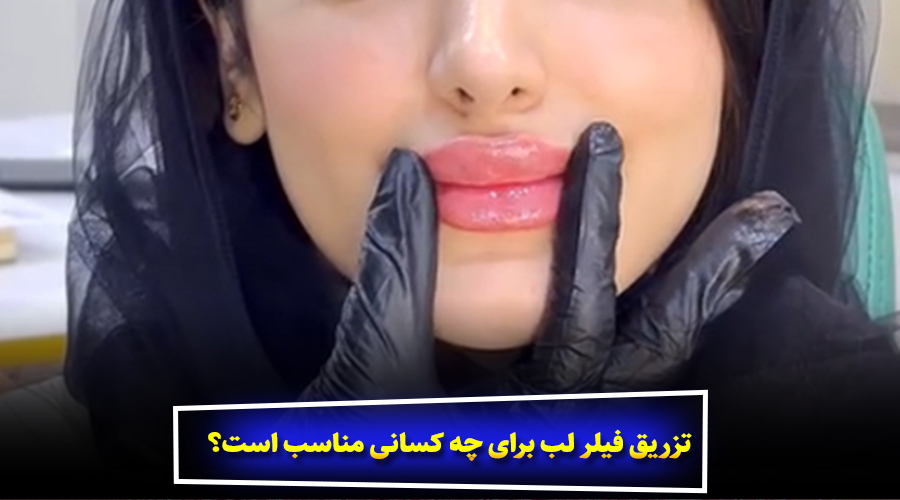 مراقبت‌های پس از تزریق فیلر لب
