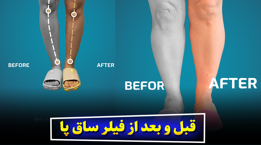قبل و بعد از فیلر ساق پا (با تصاویر نمونه)