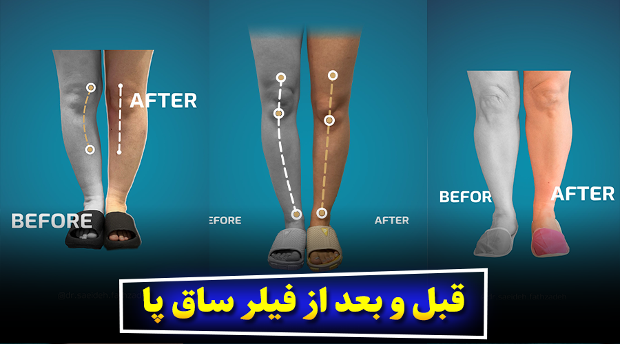 نتایج طبیعی یا فرم فانتزی؟ انتخاب نوع تزریق ساق پا