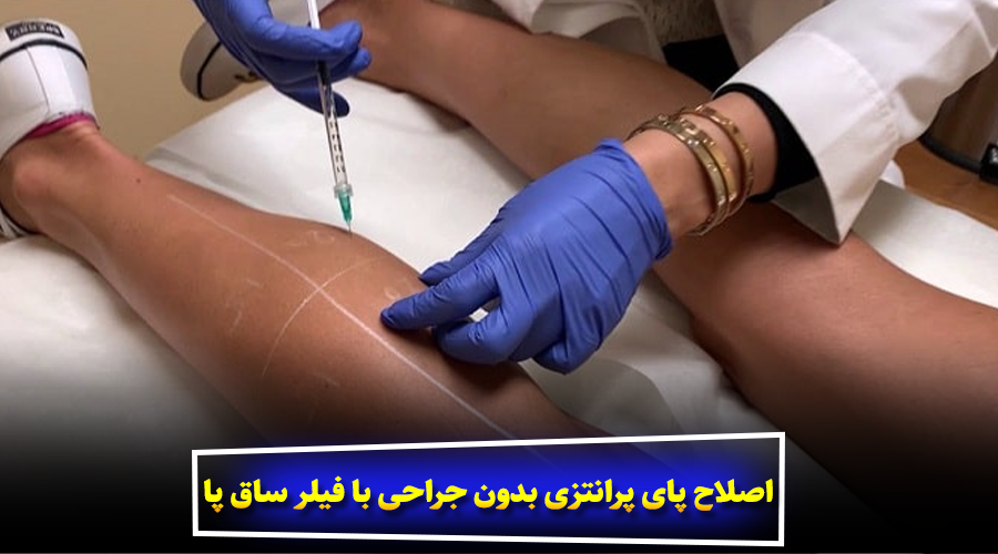 اصلاح پای پرانتزی بدون جراحی با فیلر ساق پا