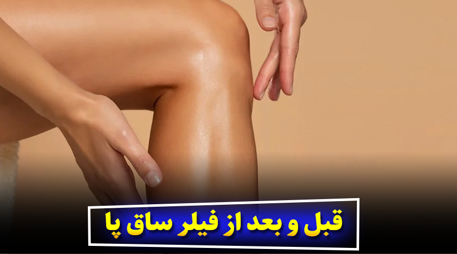 آیا تزریق فیلر ساق پا درد دارد؟