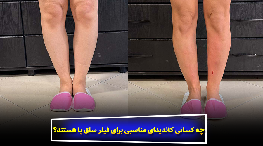 چه کسانی کاندیدای مناسبی برای فیلر ساق پا هستند؟