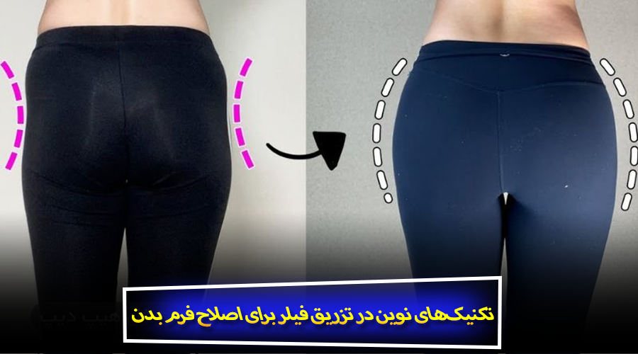 تکنیک‌های نوین در تزریق فیلر برای اصلاح فرم بدن
