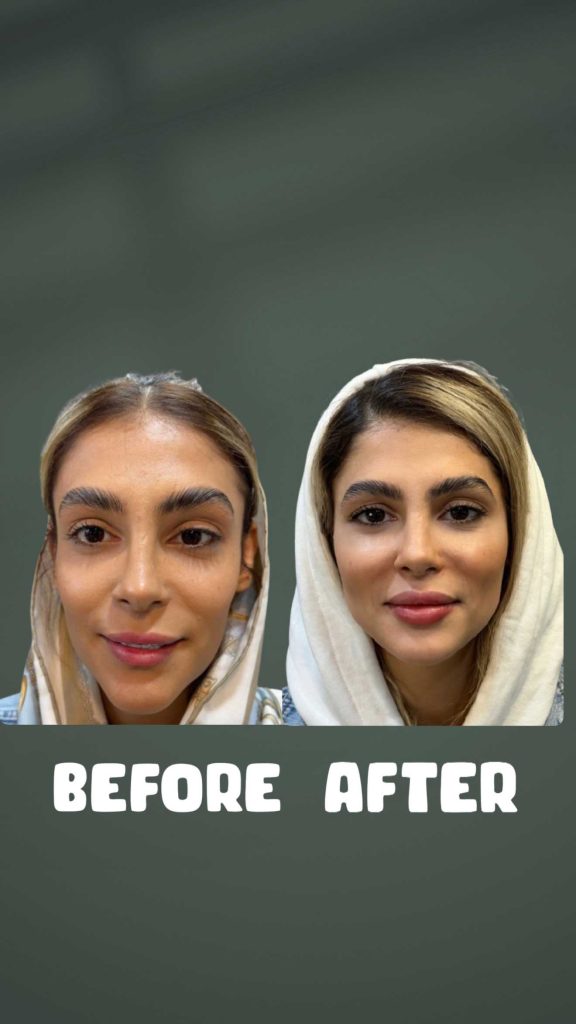 نتیجه کامل قبل و بعد از فیلر فول فیس جهت کانتورینگ و جوانسازی صورت