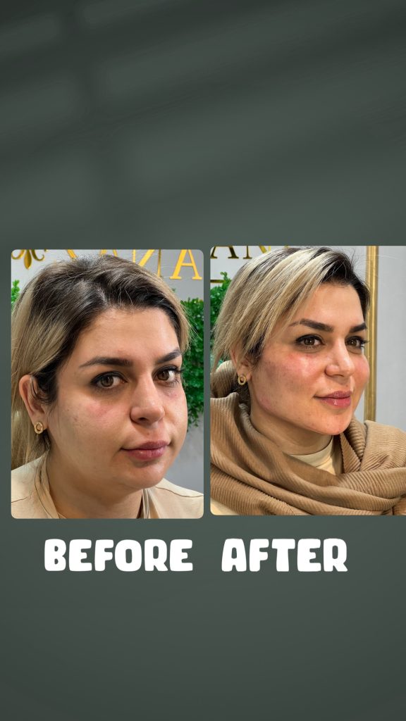 استفاده از فیلر برای حجم‌دهی و فرم‌دهی چانه
